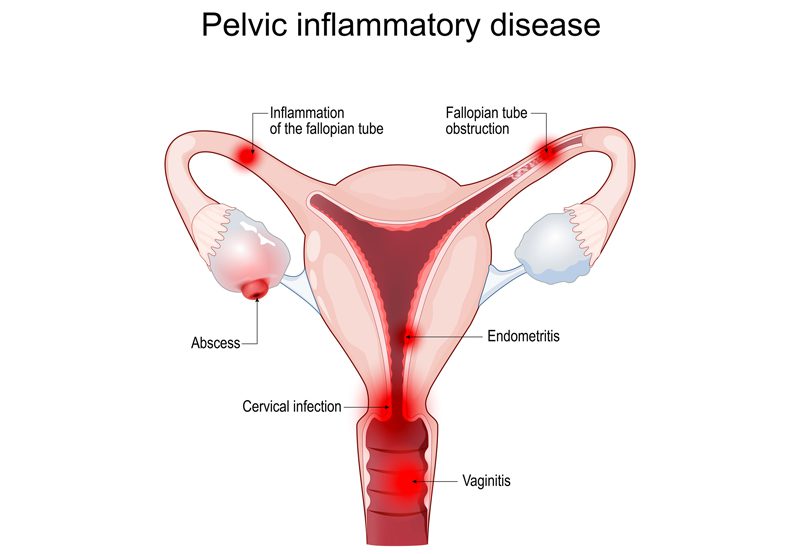 An-image-illustration-of-pelvic-inflammatory-disease