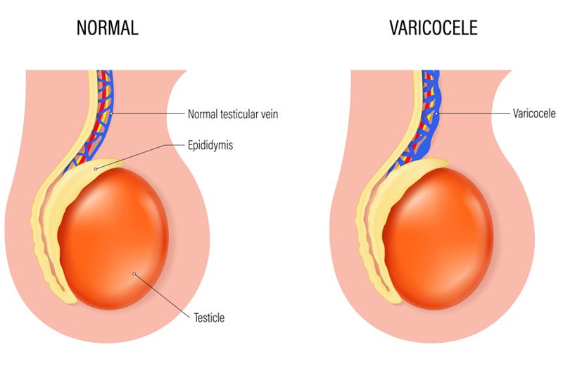 Comparison-of-normal-testicular-vein-and-varicocele Comparison-of-normal-testicular-vein-and-varicocele