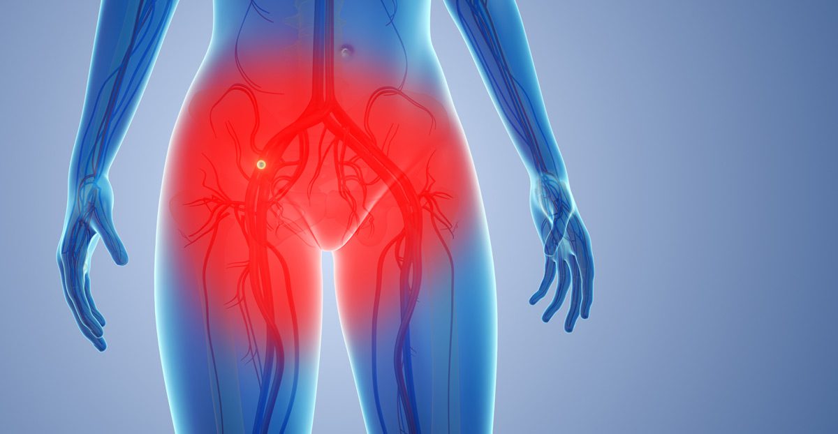 Diagram-illustrating-pelvic-pain-and-nerve-compression