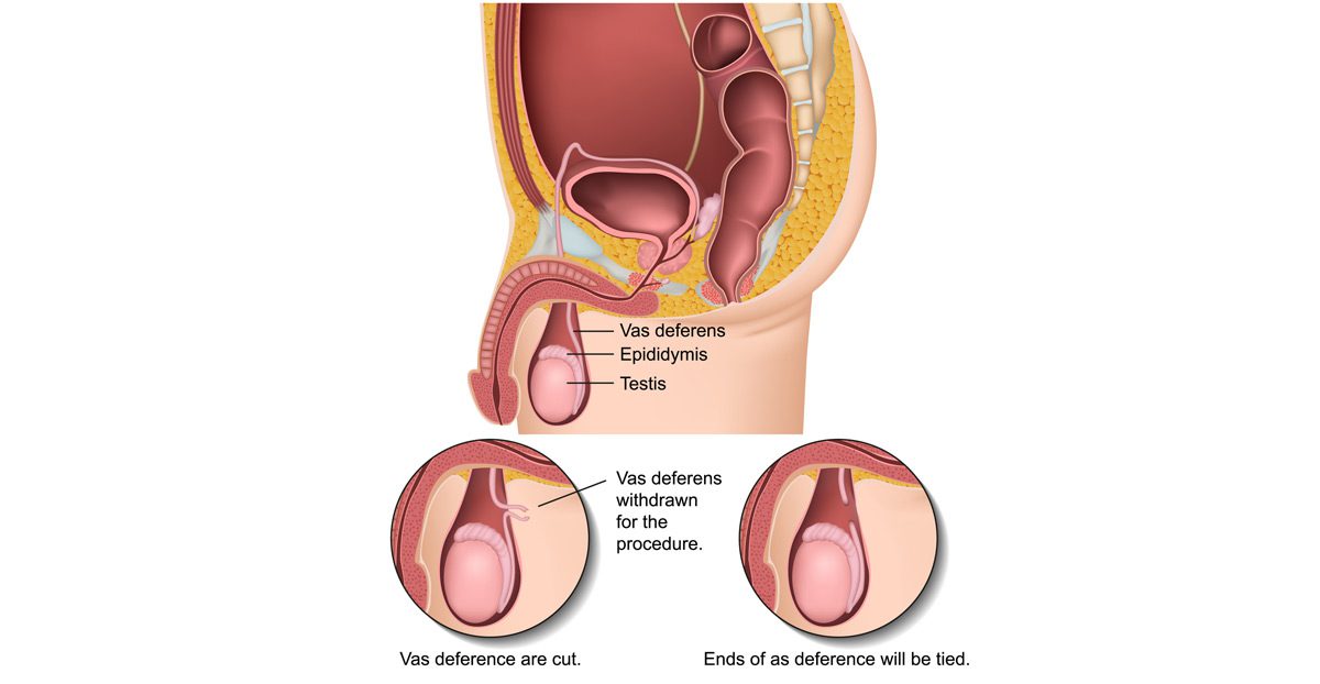 Male-vasectomy-procedure-vector