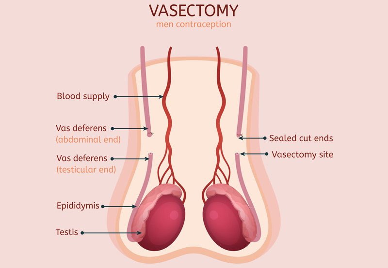Man-Vasectomy-contraception-concept