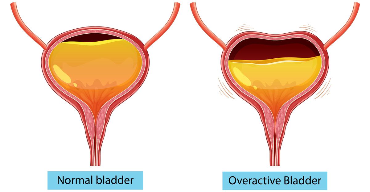 Comparison-of-normal-and-overactive-bladder